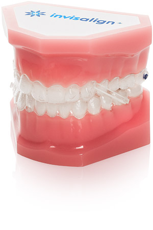 Dentico 3 - Invisalign-Methode